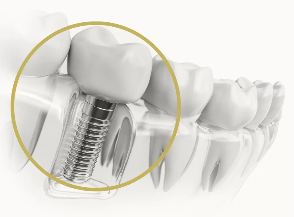 Tips To Make Your Dental Implants Last Longer